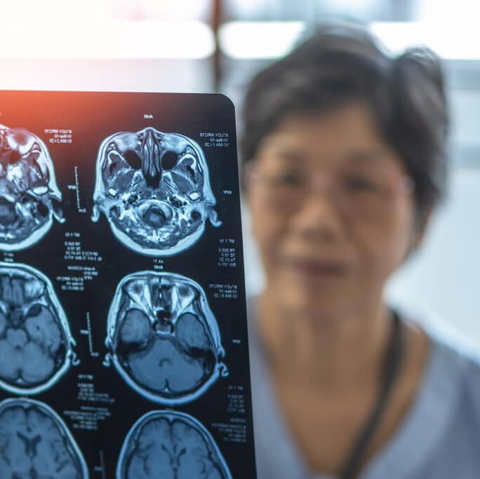 Magnetic Resonance Imaging (MRI) film for Brain disease diagnosis with medical doctor diagnosing elderly ageing patient neurodegenerative illness problem seeing for neurological medical treatment